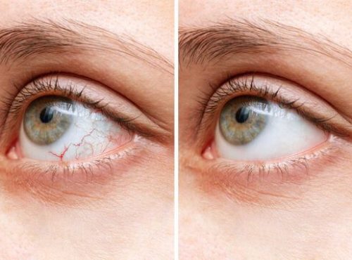 Dry Eyes Diagnosis