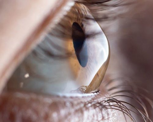 Irregular Cornea